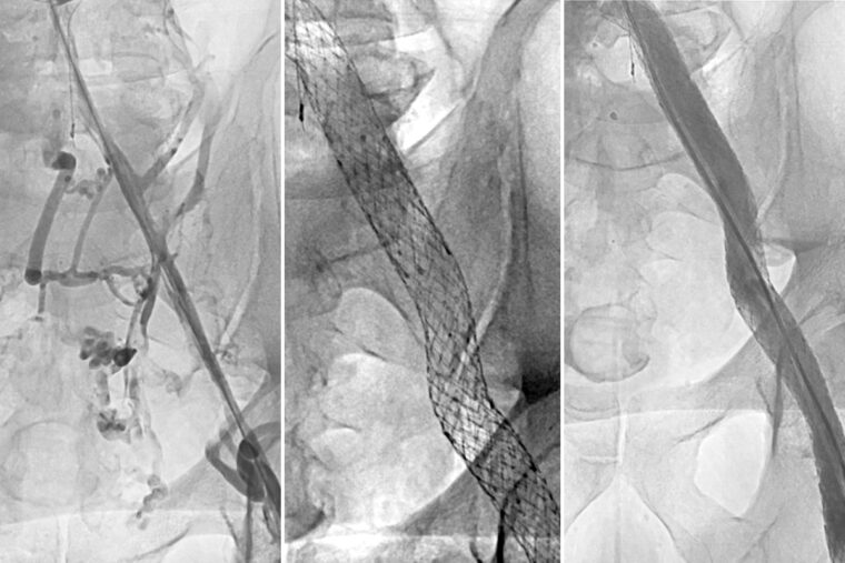 Simple procedure relieves painful complications after deep vein thrombosis